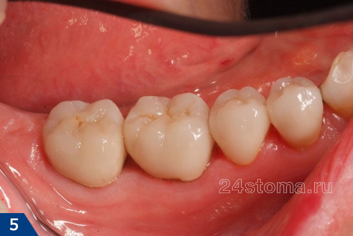 4 одиночные циркониевые коронки фиксированы на зубах