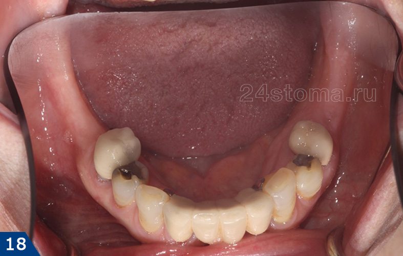 Протезирование бюгельным протезом нижней челюсти (фото до и после)