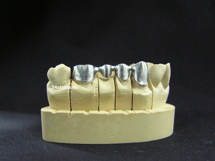 Фрезерованный металлический каркас для металлокерамического мостовидного протеза (фиксирован на гипсовой модели зубов пациента)