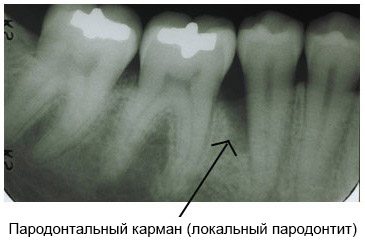 Пародонтальный костный карман в области 1-го зуба (локальный периодонтит)