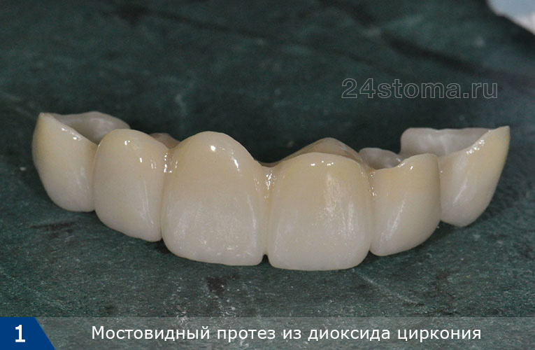 Мостовидный протез из диоксида циркония (на 6 передних верхних зубов)