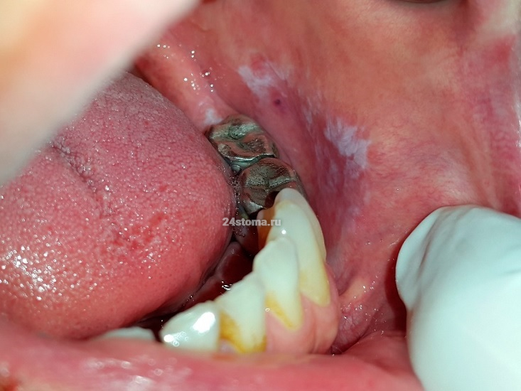 Симптомы лейкоплакии слизистой оболочки полости рта - в проекции металлических коронок