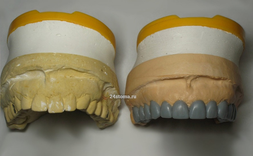 Восковое моделирование формы будущих зубов (wax ap)