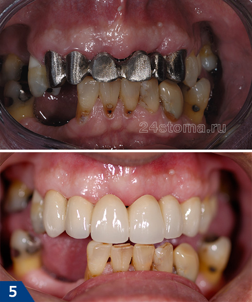 Протезирование зубов металлокерамикой (на первом фото показана примерка металлического каркаса, на втором - готовая работа)
