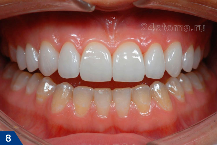 Вид готовой работы - на верхних зубах фиксировано 10 коронок из керамики Emax 