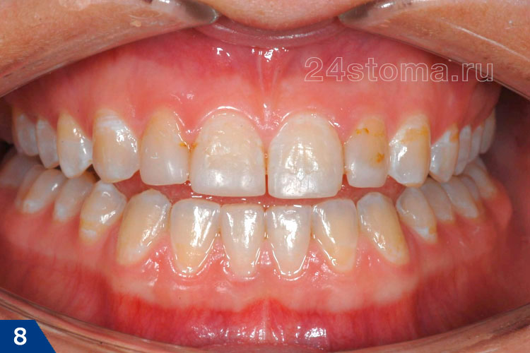 Протезирование верхних передних зубов - исходная ситуация