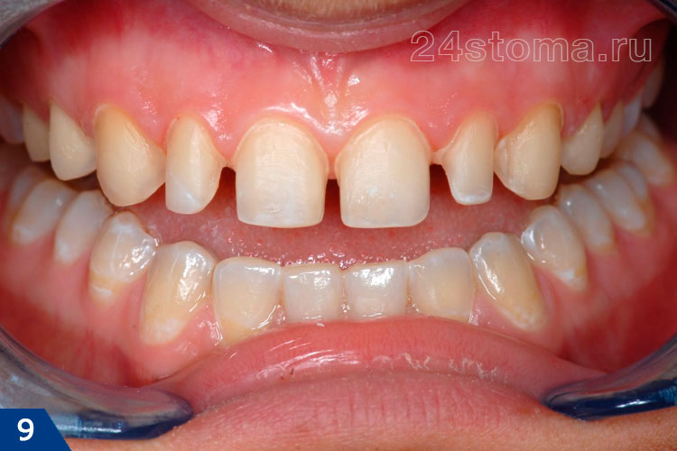Передние верхние 10 зубов обточены под коронки