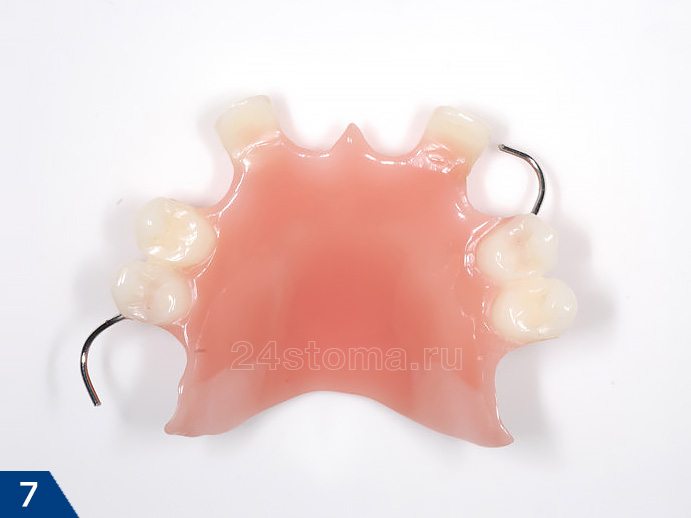 Съемный протез из пластмассы при частичном отсутствии зубов (имеет два кламмера из металической проволоки)