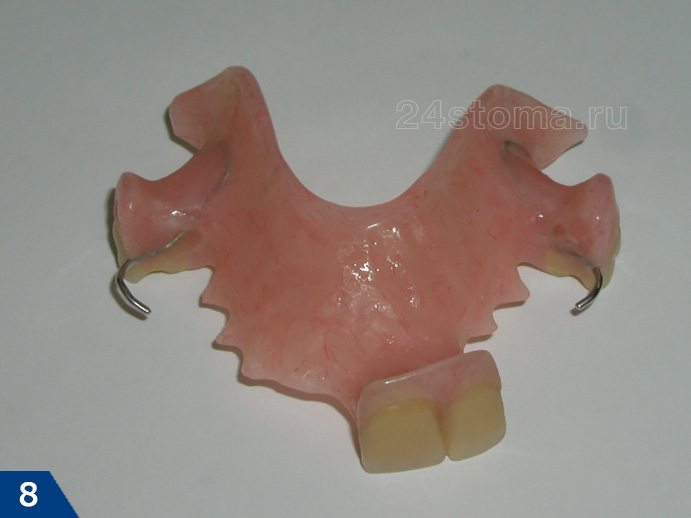 Съемный протез из пластмассы при частичном отсутствии зубов (вид со стороны, которая будет прилегать к слизистой оболочке протезного ложа)