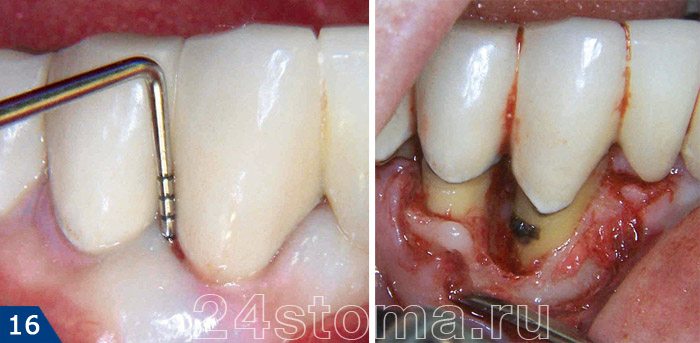 Глубокий пародонтальный карман при пародонтите (карман визуально видно только после хирургической отслойки десны). На поверхности корня зуба мы видим поддесневой зубной камень черного цвета.