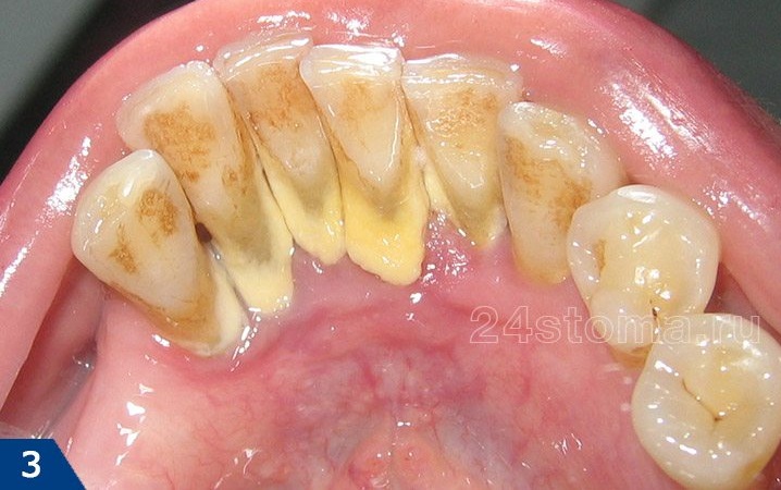Зубной камень н язычной поверхности передних нижних зубов