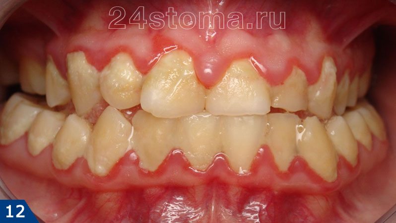 Острый катаральный гингивит (огромное количество мягкого микробного зубного налета, покраснение и отек десневых сосочков)