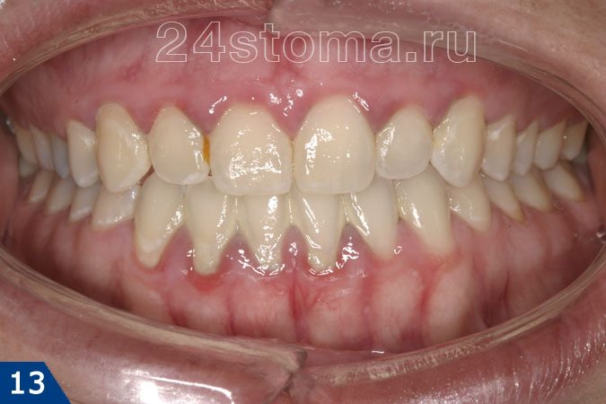 Хронический катаральный гингивит (небольшое количество мягкого микробного зубного налета, наличие поддесневого зубного камня, отек и резкая синюшность десневых сосочков)