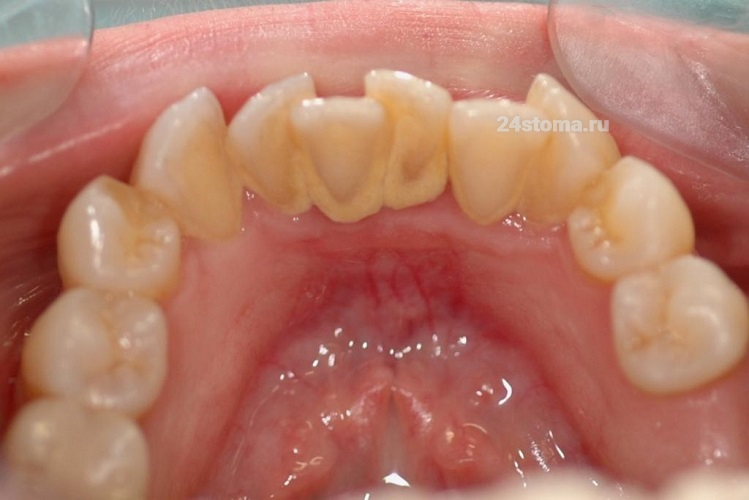 Ультразвуковая чистка зубов (исходное состояние)