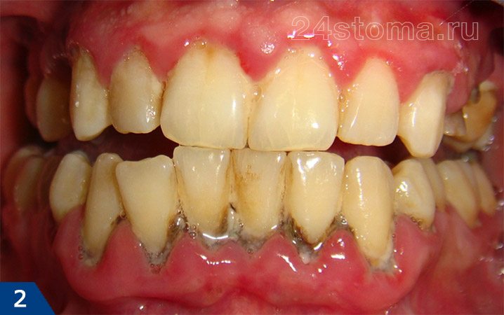 Обильные отложения зубного камня в области нижних зубов, а также мягкого микробного зубного налета в области всех зубов