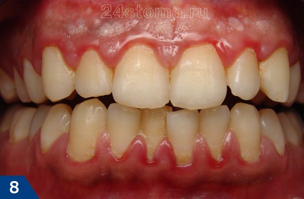 Скопления мягкого зубного налета в области шеек зубов