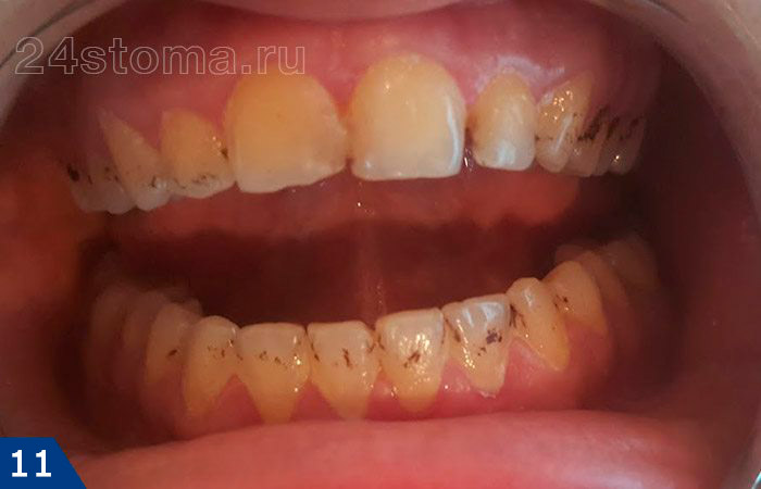 Черный налет на зубах у ребенка, появившийся в следствие отложения солей железа (хромогенное окрашивание)