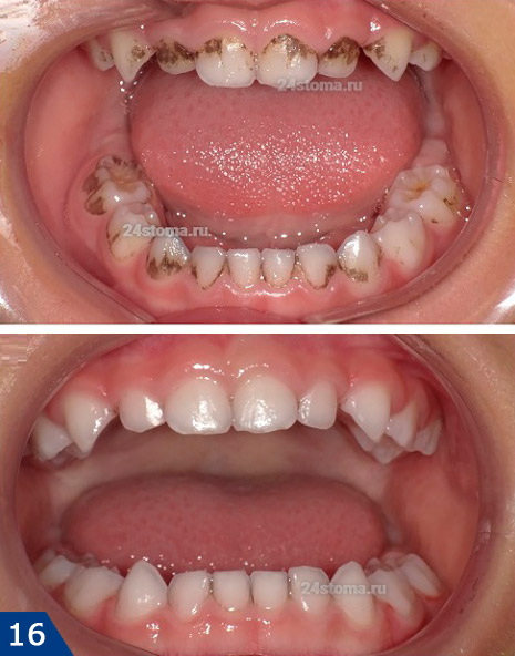 Удаление хромогенного окрашивания зубов у ребенка