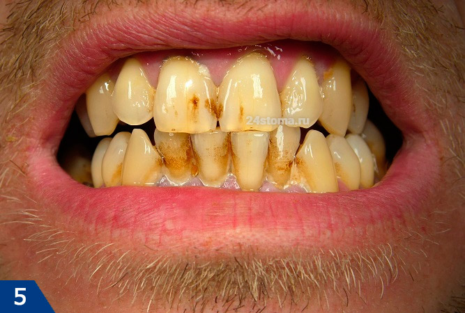 Зубы курильщика: мы видим большое количество микробного зубного налета, пигментного налета, а также глубокие пигментации эмали верхних резцов