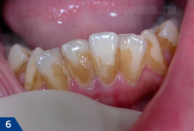 Коричневый налет на зубах на фоне потребления большого количества кофе. Обратите внимание, что пигментация произошла именно в тех областях, где зубы покрыты слоем микробного зубного налета.
