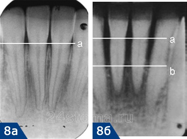 Рентгенограмма 8а - уровень костной ткани при отсутствии пародонтита. Рентгенограмма 8б - разрушение костной ткани на 1/2 длины корня (при пародонтите средней степени тяжести)