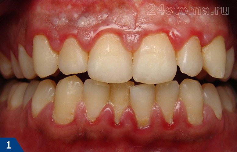 Скопления мягкого зубного налета в области шеек всех зубов