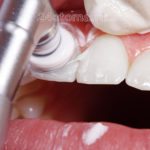 Cнятие зубных отложений - варианты удаления налета