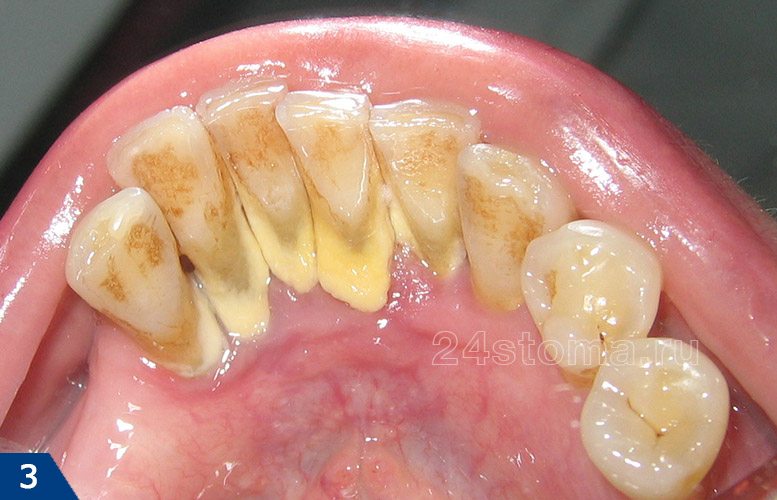 Твердые зубные отложения на внутренней поверхности нижних зубов