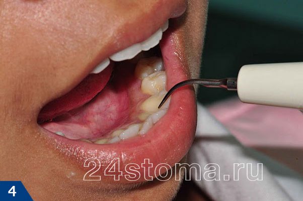 Вид рабочей насадки ультразвукового наконечника во рту у пациента