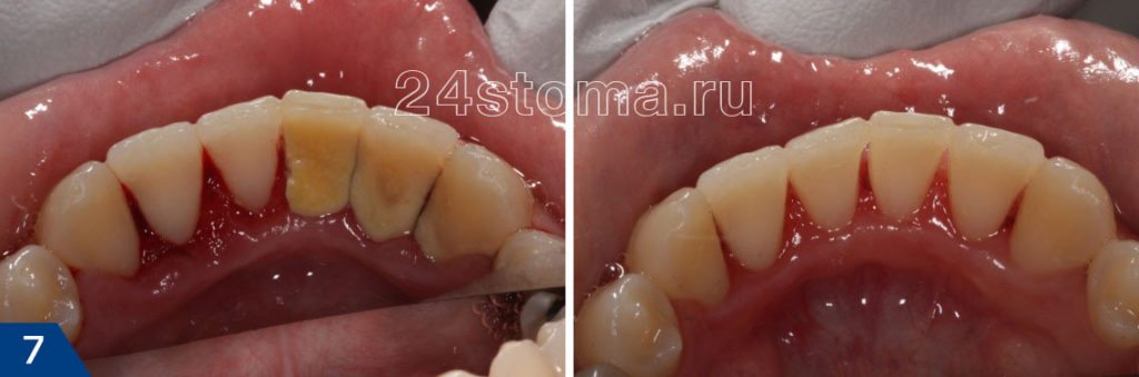 Ультразвуковая чистка зубов фото до и после