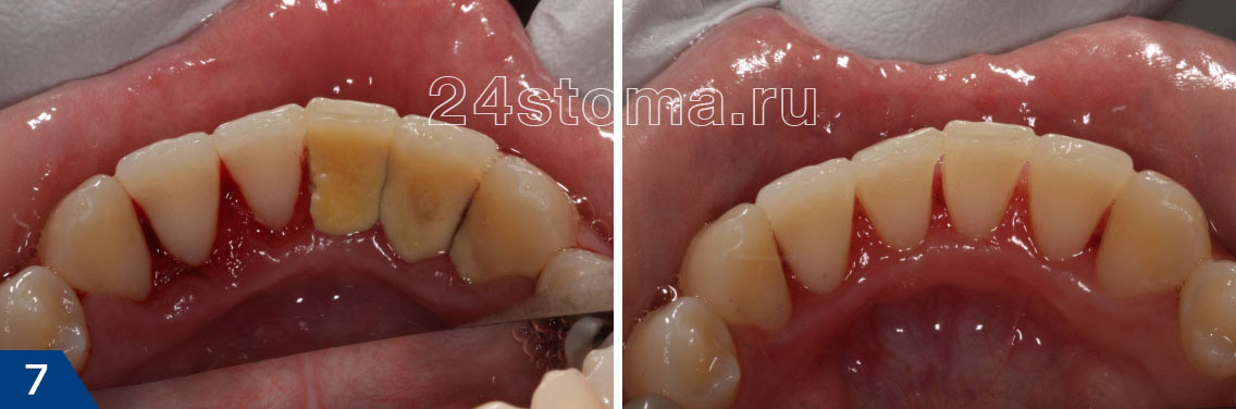 Вид зубов в процессе удаления твердых зубных отложений и конечный результат