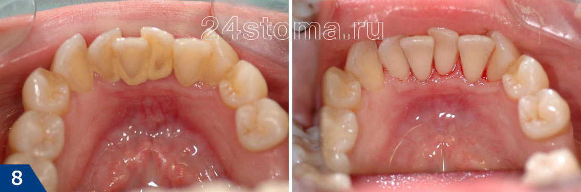 Вид зубов до и после снятия зубного камня ультразвуком