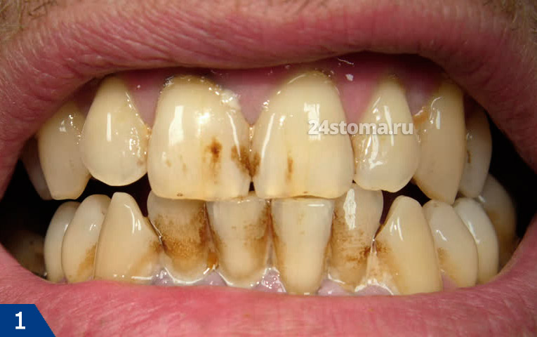 Темный налет на зубах у курильщика (+ бактериальный налет, + стойкое изменение цвета некоторых участков эмали) 