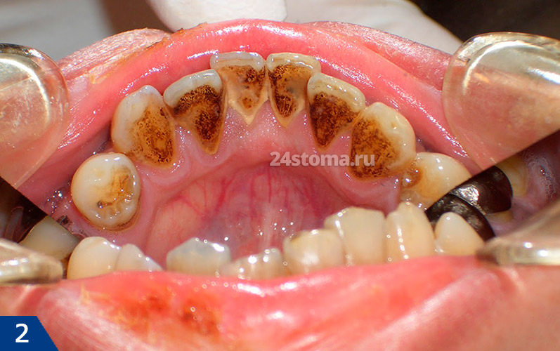 Темный налет на зубах (на язычной поверхности нижних зубов)
