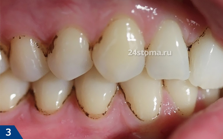 Черный налет на зубах, связанный с активностью актиномицетов и отложением нерастворимых солей железа