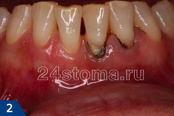 Твердые зубные отложения в пришеечной области нижних зубов