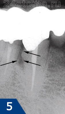 Рентгенограмма пародонтального кармана между двумя зубами