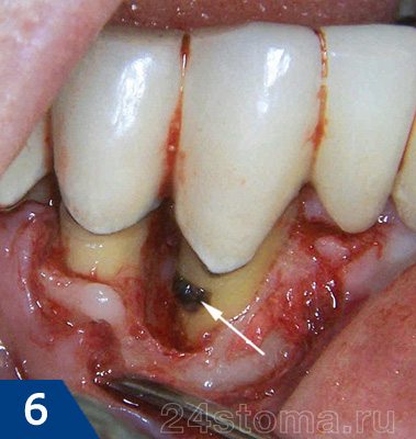 Вид пародонтального кармана после отслойки десны от зубов (в процессе операции кюретажа)