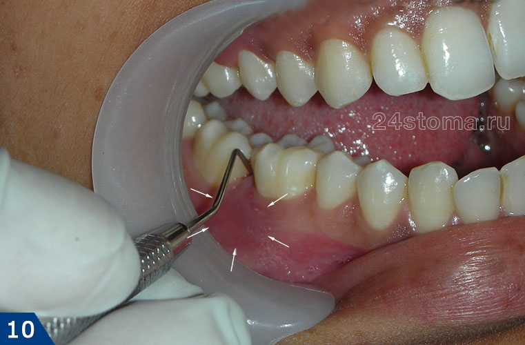 Локализованный пародонтит (стрелочками ограничен очаг припухлости десны в области 6 зуба). Причина - травматический преждевременный контакт с верхним зубом.