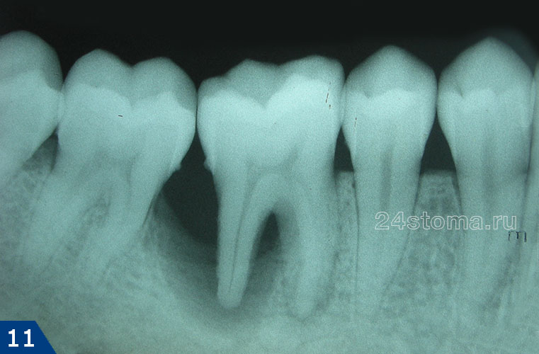 Рентгенограмма зуба с локализованным пародонтитом с рис.5 (виден большой очаг разрушения кости в области дистального корня 6 зуба и межзубном промежутке)