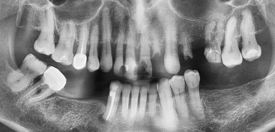Панорамный снимок зубов пациента