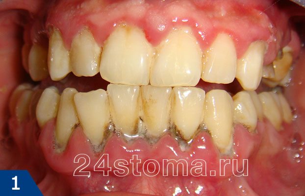 Хронический генерализованный пародонтит легкой степени (большое количество мягких и твердых зубных отложений, отек и покраснение десны вокруг шеек зубов)