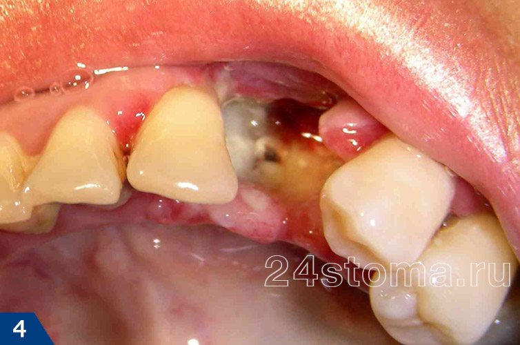 Альвеолит (воспаление лунки удаленного зуба)