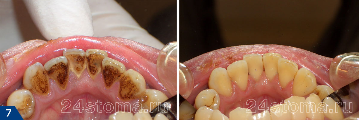 Удаление зубных отложений ультразвуком