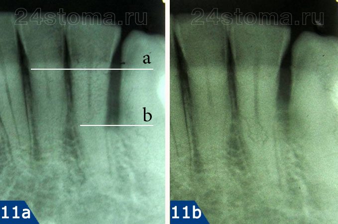 Рентгенограмма 11а - снимок ДО лечения. Рентгенограмма 11b - снимок через 3 месяца после открытого кюретажа и подсадки костной ткани