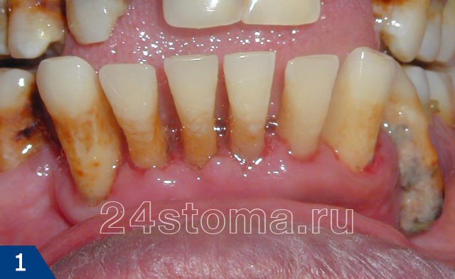 Пародонтит средне-тяжелой степени. Клинически определяется оголение шеек зубов, расхождение зубов, подвижность зубов и т.д.