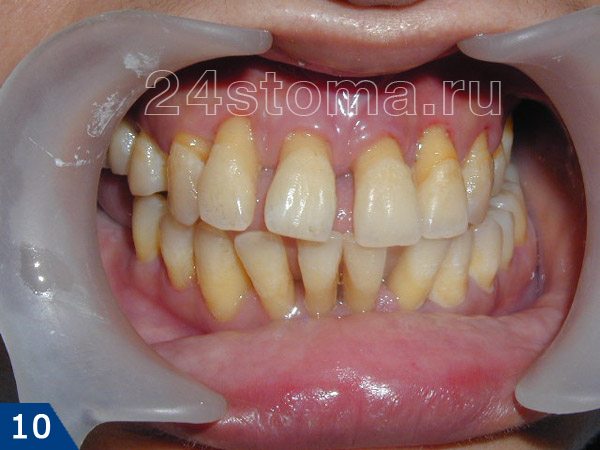 Исходная ситуация: веерообразное расхождение верхних и нижних зубов при пародонтите