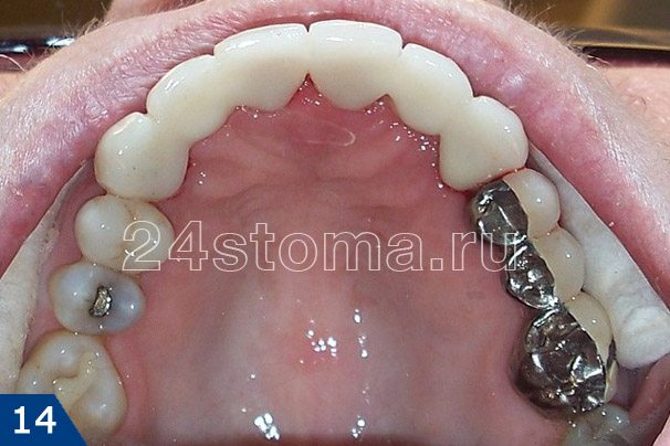 Шинирующий протез из металлокерамических спаянных друг с другом коронок на 6-ти верхних передних зубах