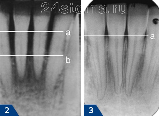 Рентгенограмма (2) - атрофия костной ткани на 1/2 длины корня. Рентгенограмма (3) - отсутствие разрушения костной ткани.