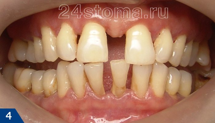 Веерообразное расхождение нижних/верхних зубов, оголение шеек зубов вследствие атрофии костоной ткани при пародонтите